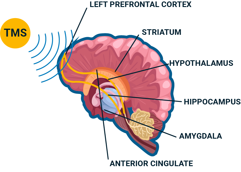 Técnica de TMS ilustrada para mejorar la salud mental